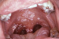 Detalhe de lesão por Candida na língua